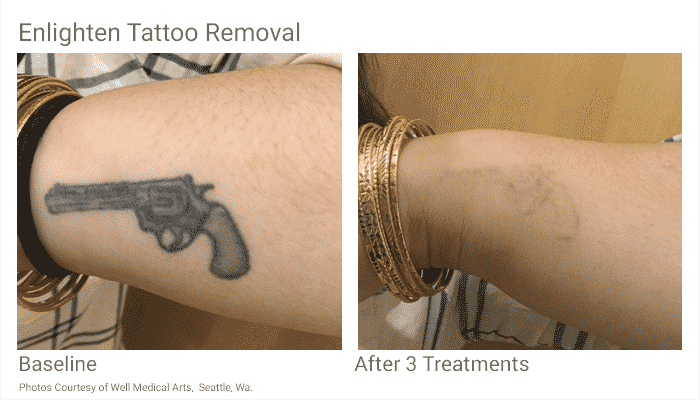 Tattoo Removal in Seattle at Well Medical Arts