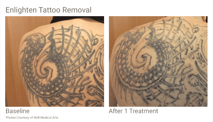 Tattoo Removal In Seattle Just Became Easier. With Pico Technology At ...