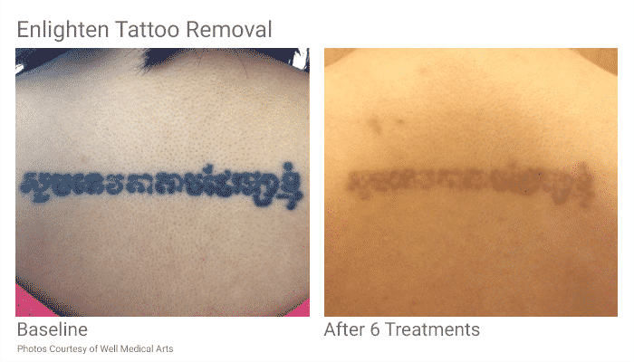 Tattoo Removal in Seattle at Well Medical Arts