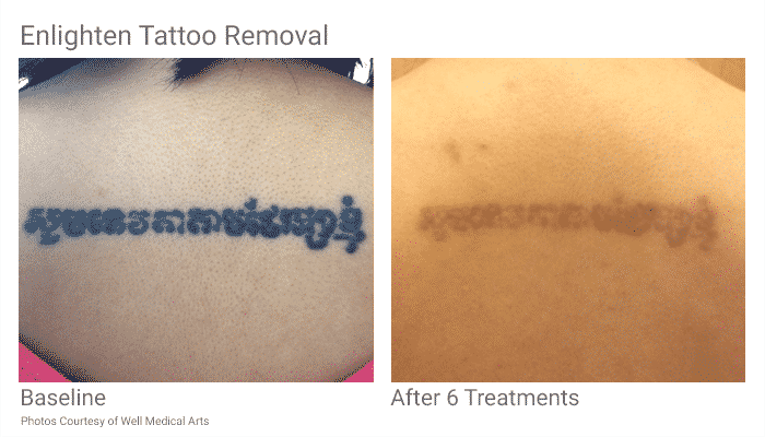 Tattoo Removal In Seattle Just Became Easier. With Pico Technology At ...