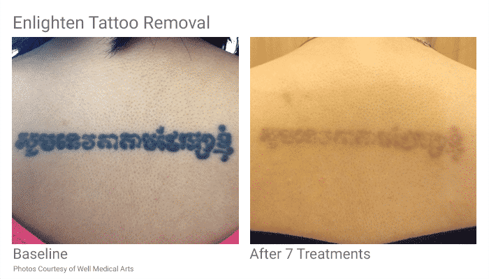 Tattoo Removal In Seattle Just Became Easier. With Pico Technology At ...