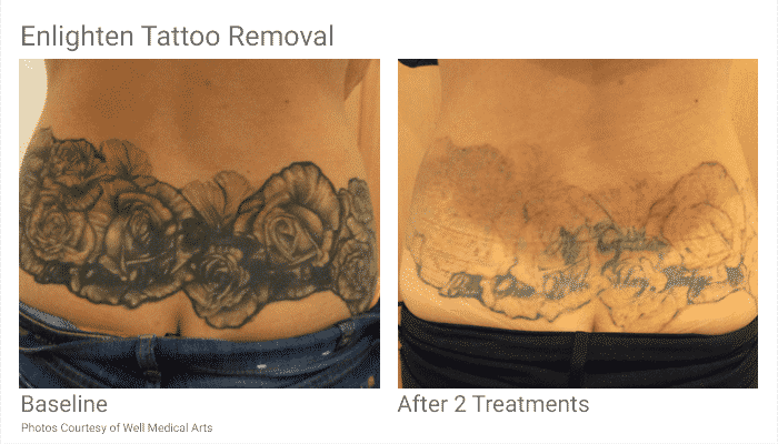Tattoo Removal Seattle | tattoo removal in seattle at well medical arts Tattoo Removal Seattle | tattoo removal in seattle at well medical arts