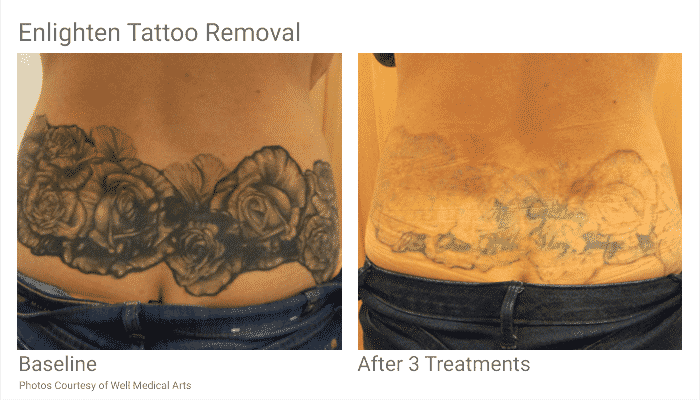 Tattoo Removal In Seattle Just Became Easier. With Pico Technology At ...