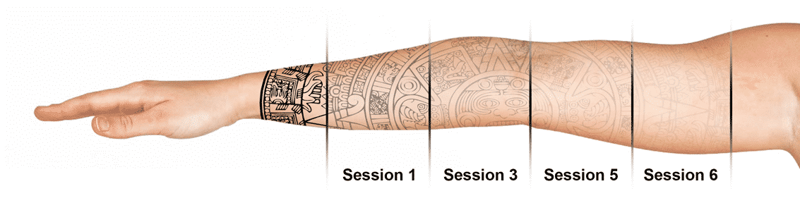tattoo removal in seattle using pico technology at well medical arts tattoo removal in seattle using pico technology at well medical arts