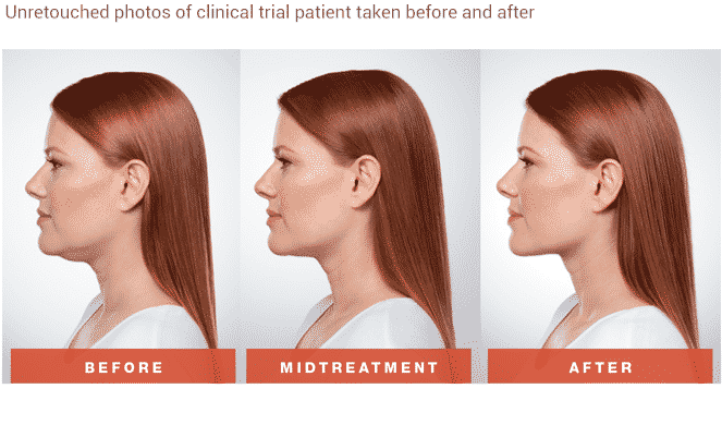 Seattle Kybella at Well Medical Arts. Kybella is the new injectable that permanently dissolves fat with a quick non-invasive procedure providing contour to the lower face and jawline.