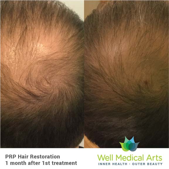 Seattle PRP Hair Restoration - 1 Month post 1 Treatment