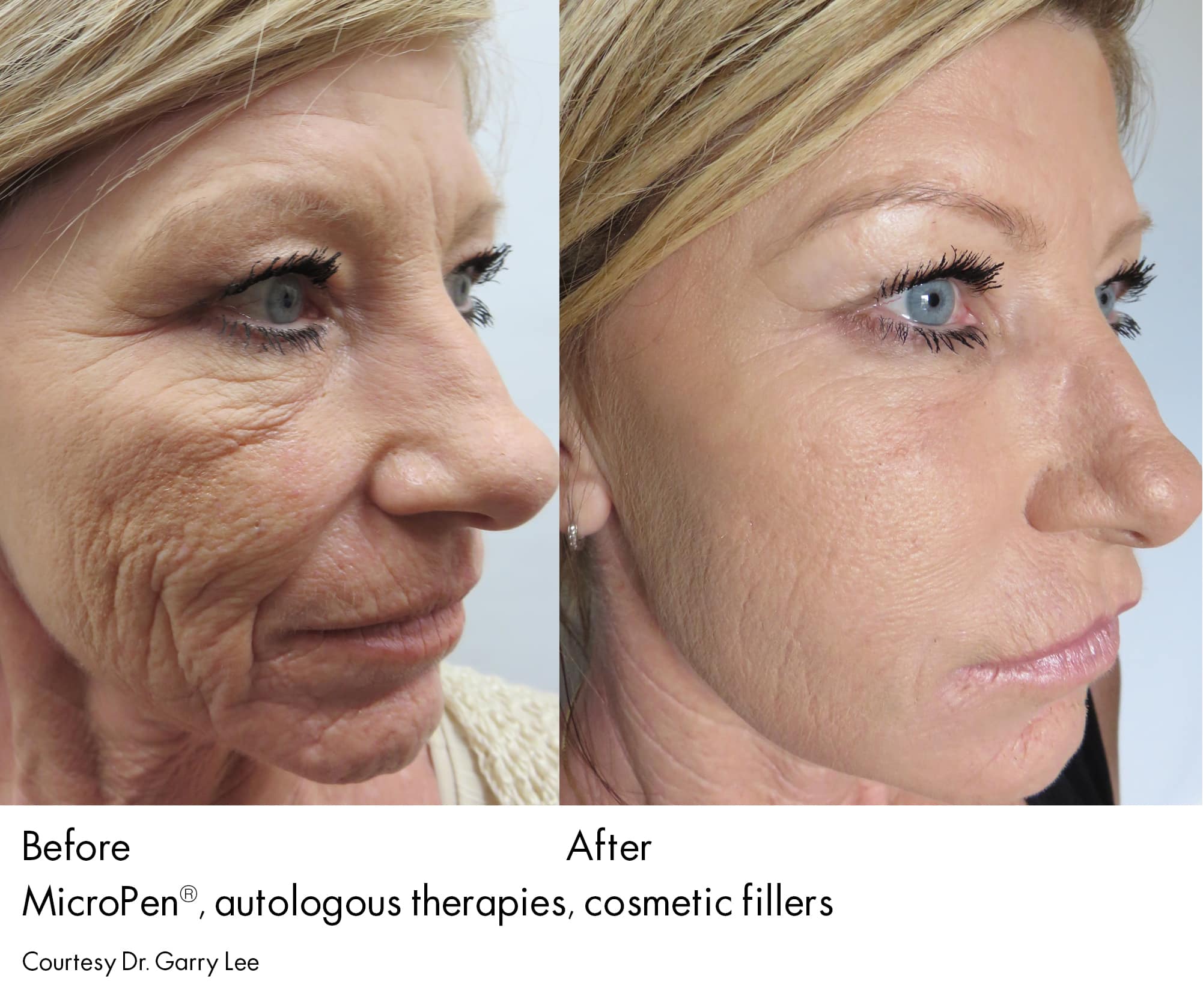 microneedling with growth factors microneedling with growth factors