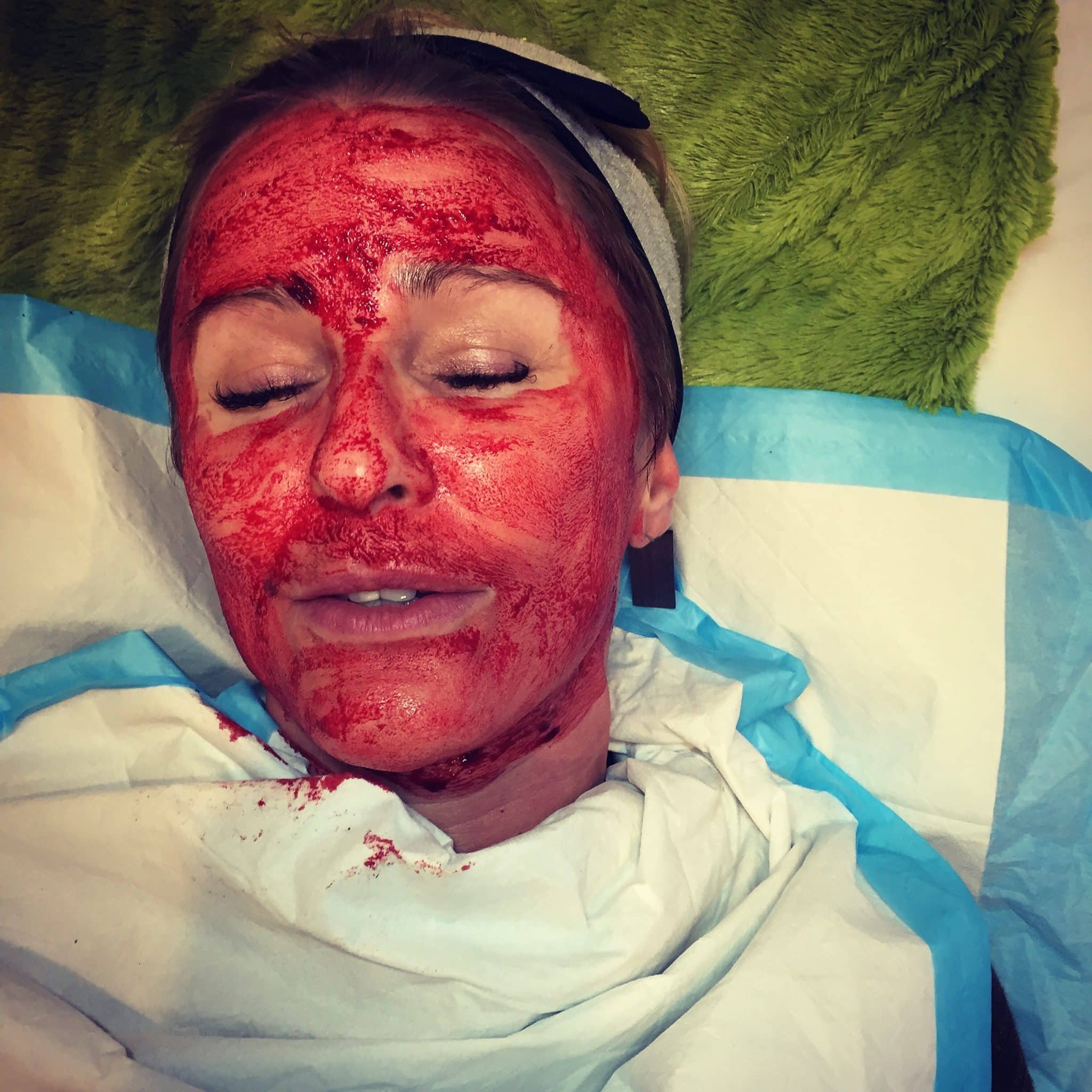 Dominique undergoing the Vampire Facial in Seattle. The vampire facial is MicroNeedling with Platelet Rich Plasma (PRP) applied topically.