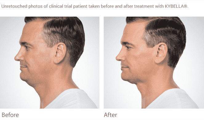 Eliminate the Double chin in Seattle with Kybella at Well Medica Arts. We have a full line of Mens treatments from Botox to Testosterone to Viagra. Call us at 206-935-5689 to find out more.