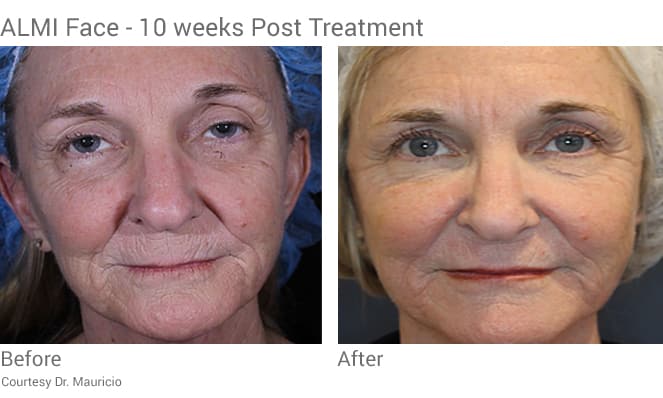 Almi procedure full face rejuvenation with stem cells from fat transfer.