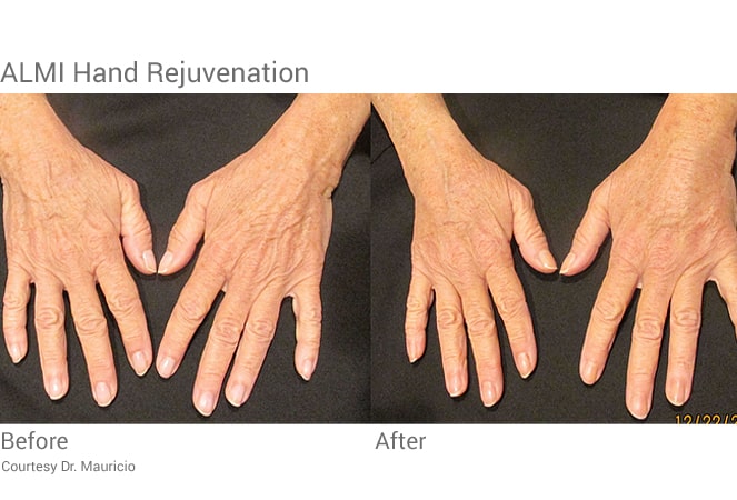 Almi procedure hand rejuvenation with stem cells from fat transfer.