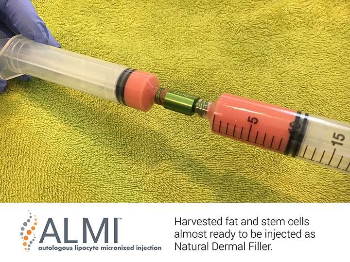 Harvested fat and stem cells being prepared to be re injected as a Natural Dermal Filler at Well Medical Arts in Seattle