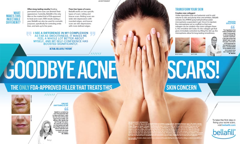 Say goodbye to acne scars with our Seattle Bellafill Acne Scar treaments.