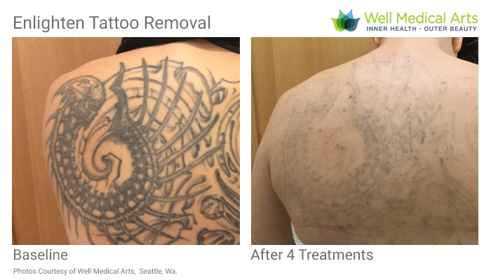 tattoo removal in seattle using pico technology at well medical arts tattoo removal in seattle using pico technology at well medical arts
