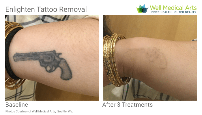 100+ [ Body Beautiful Tattoo Removal Laser ] | Hindsight ...